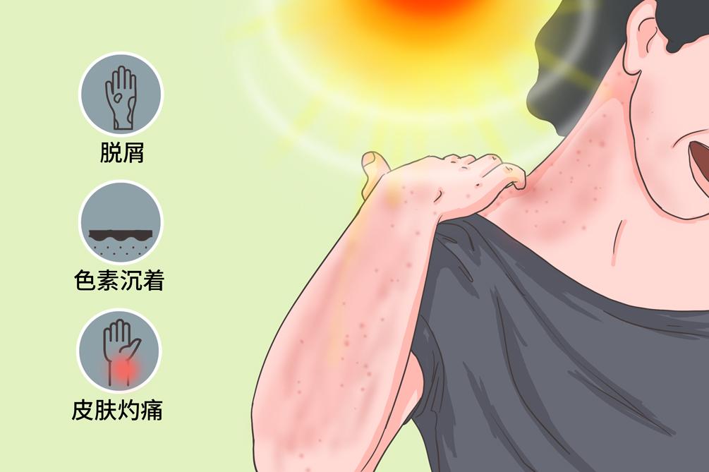 紫外线强烈,长时间暴露在阳光下可能导致日光性皮炎,表现为皮肤发红