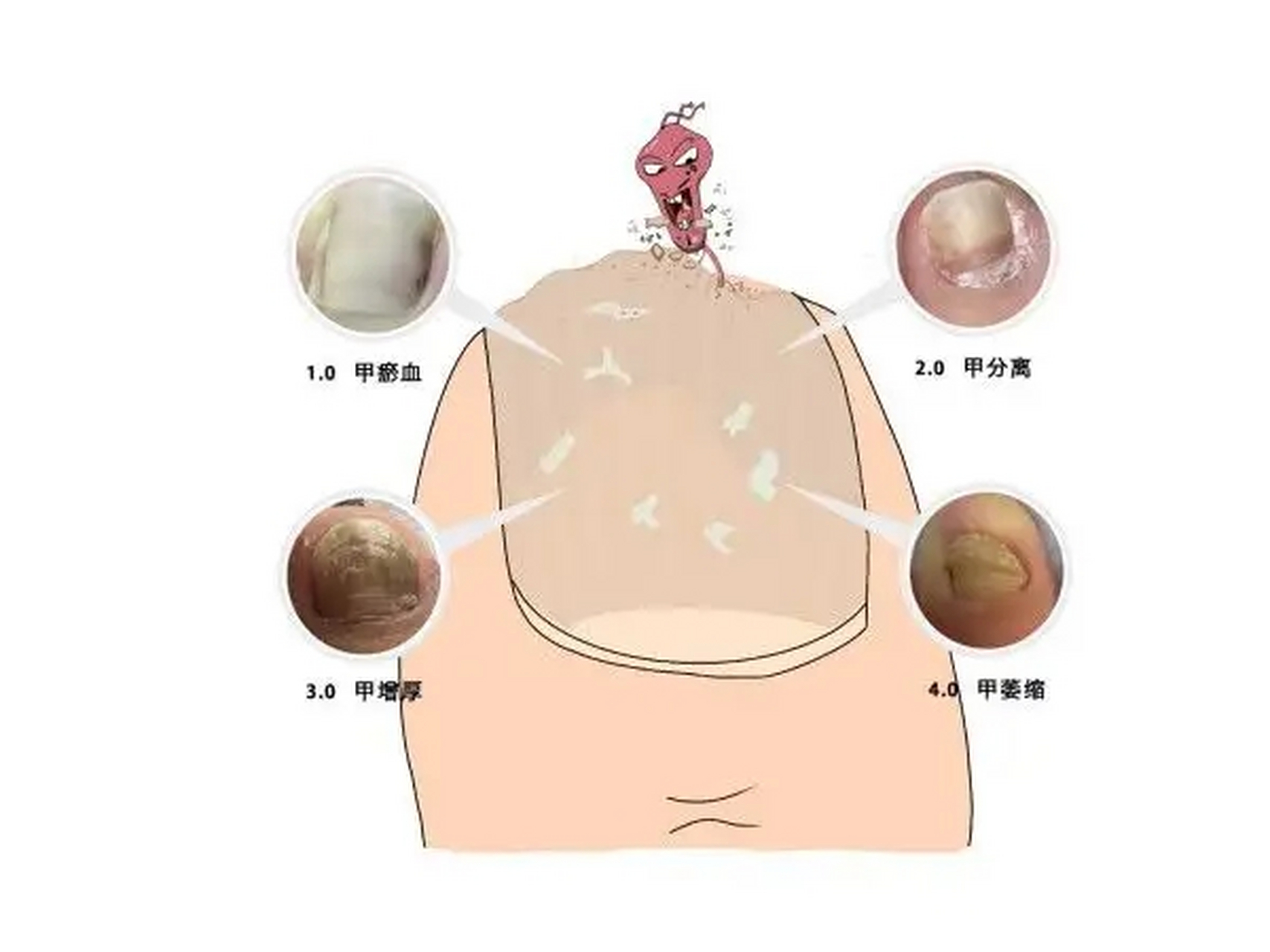 灰指甲学名甲癣,是由皮肤癣菌感染所导致的一种甲病,要确定是不是得了