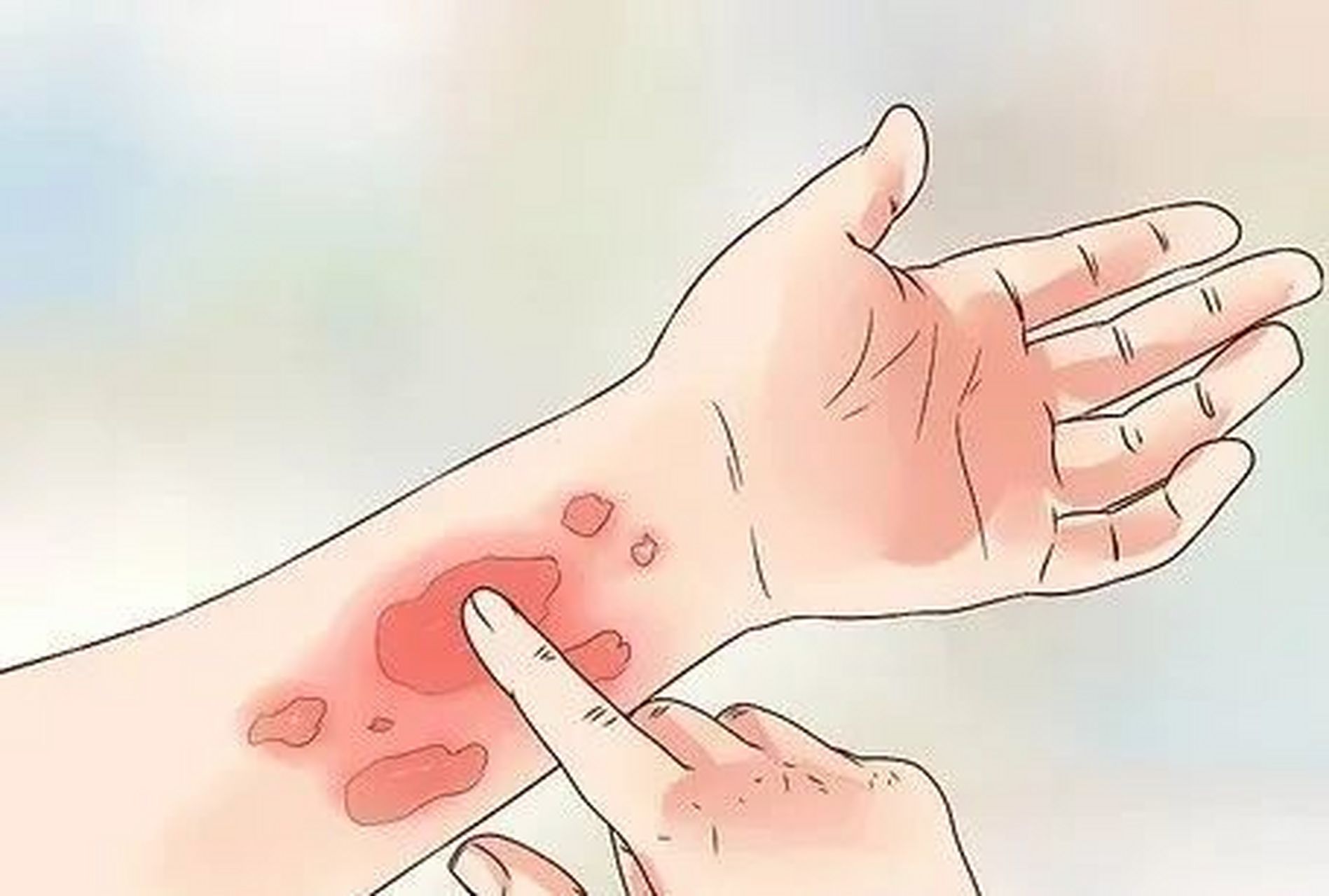 荨麻疹是常见的皮肤疾病,以其突发的红色或苍白色风团和伴随的剧烈