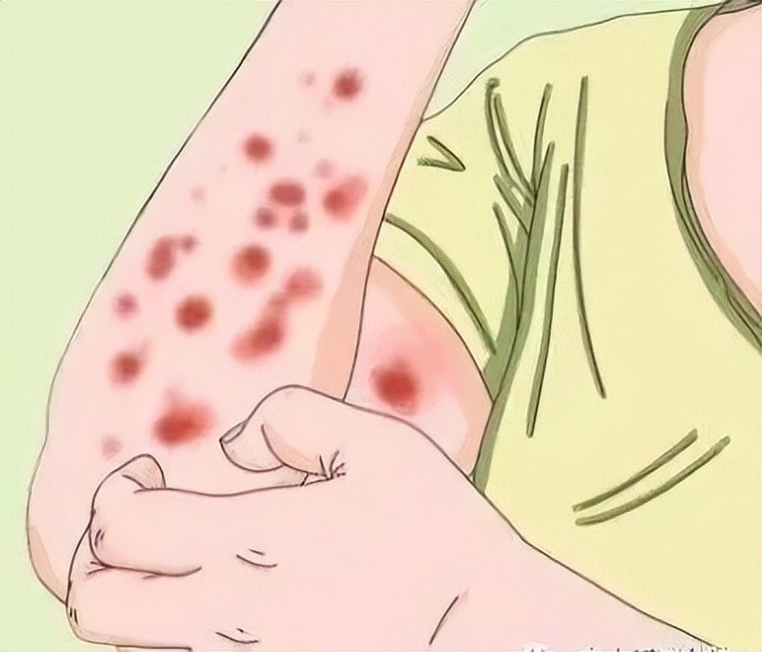 荨麻疹是常见的皮肤疾病,以其突发的红色或苍白色风团和伴随的剧烈