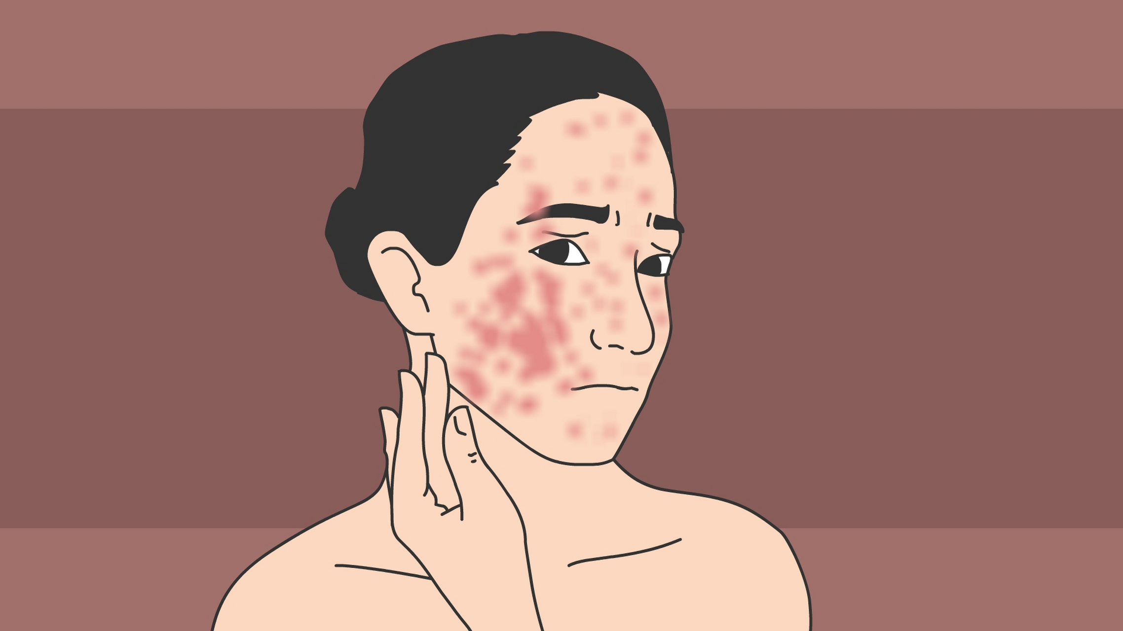 脂溢性皮炎是发生于皮脂溢出部位的一种慢性炎症性皮肤病.