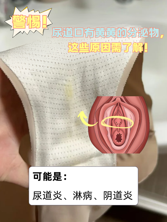 尿道炎:可能是细菌,病毒,尿道口正常标准图片女性尿道口图片正车哪