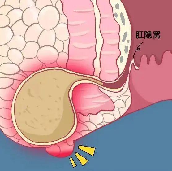 肛门直肠周围脓肿图片