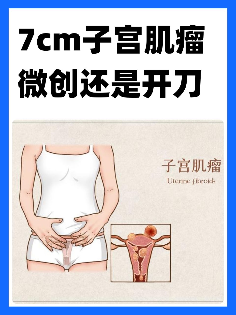子宫肌瘤为什么要切除子宫