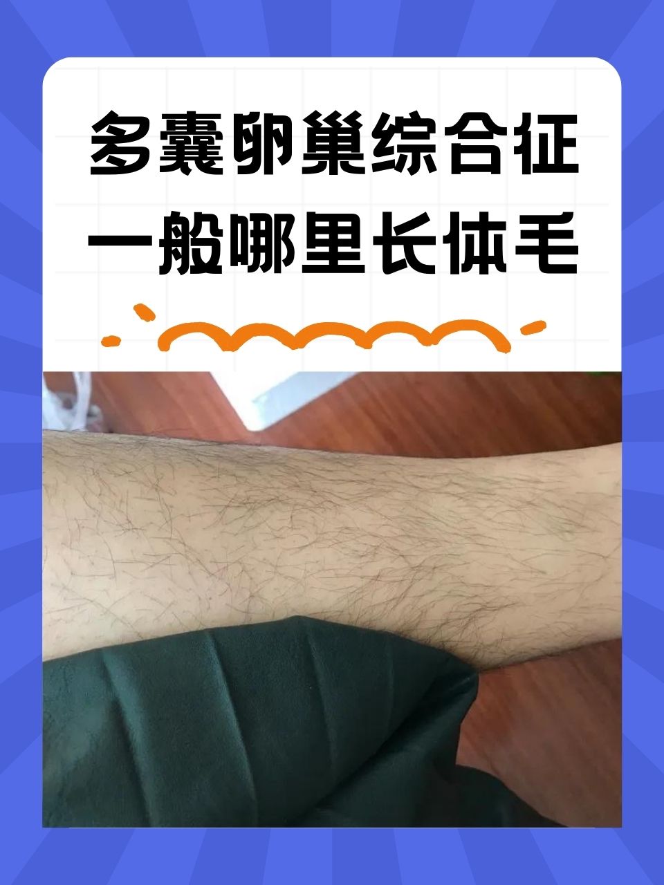 多囊卵巢综合征一般是哪里长体毛  多囊卵巢综合征是一种常见的妇科