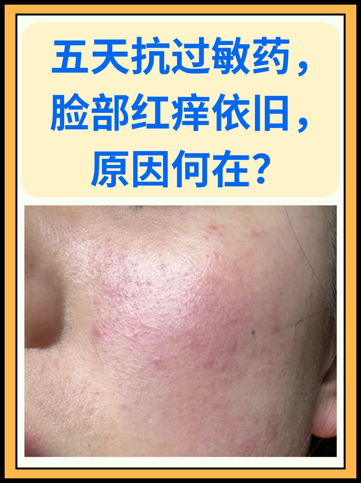 脸部过敏,红肿发痒,是许多人都不愿面对的肌肤问题