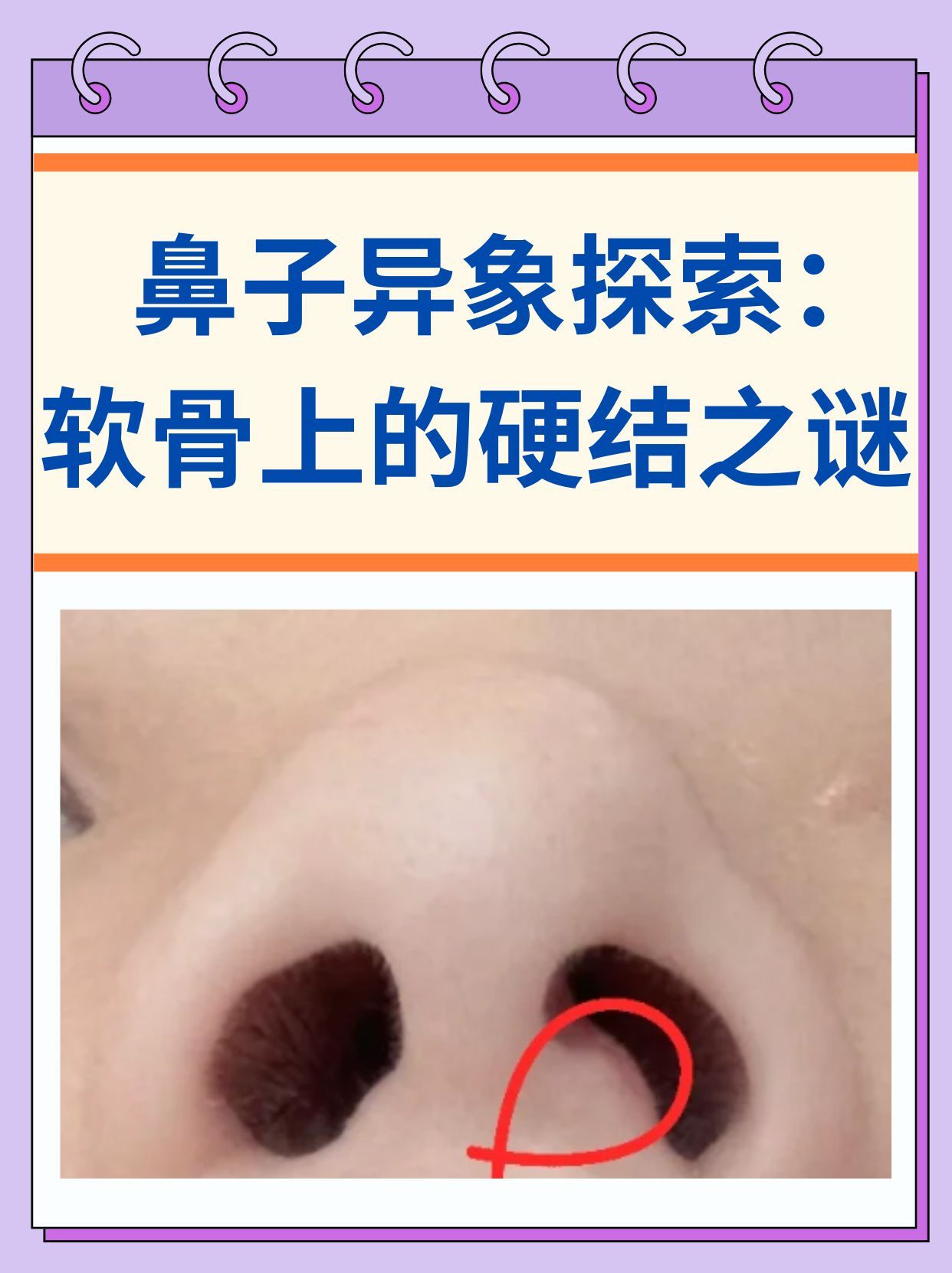 鼻子异象探索:软骨上的硬结之谜 你是否曾在触摸鼻子