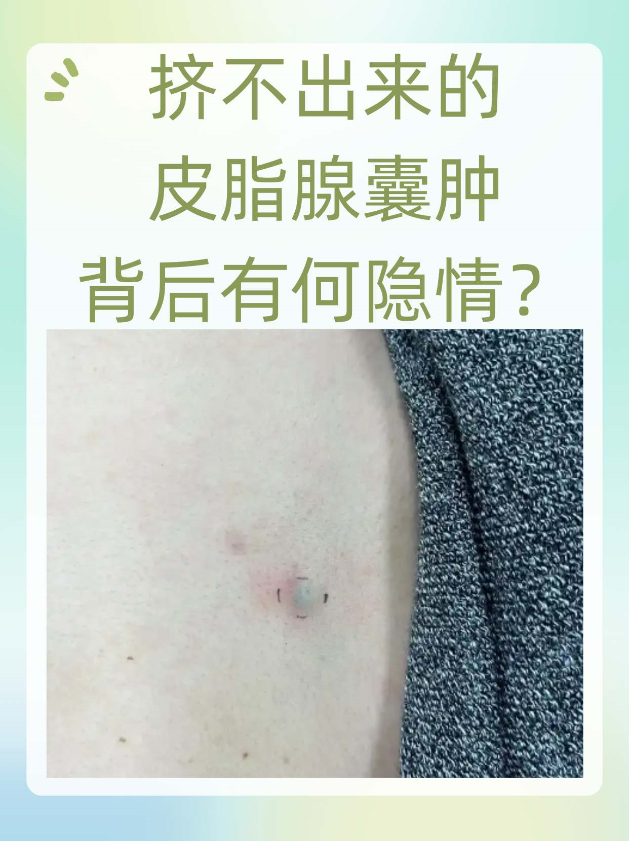 挤不出来的皮脂腺囊肿,背后有何隐情?