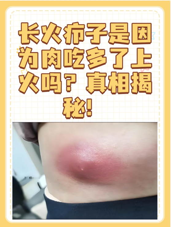 "那么,长火疖子真的和肉