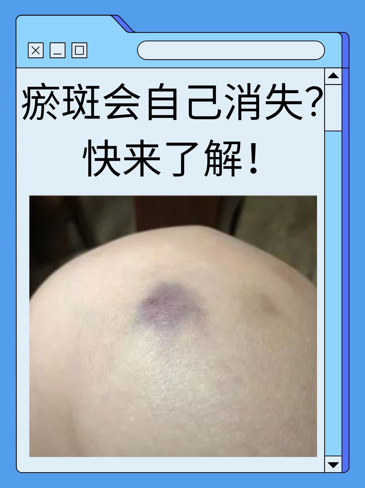 它又会瘀斑白血病初期瘀斑图片淤青1一7天变化图皮肤瘀斑图片白血病的