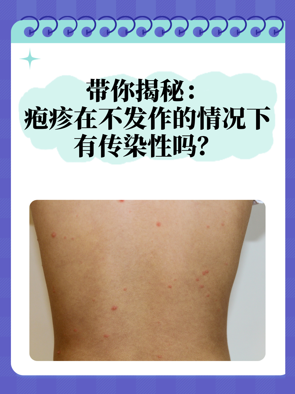 疱疹听起来就让人头疼的皮肤病,总是让人心生畏惧