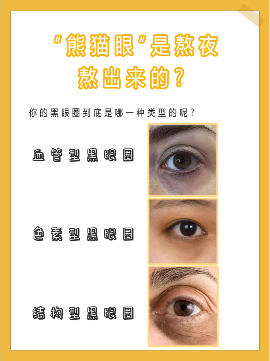 每天一个健康小技巧~ 血管型黑眼圈 ①如何判断 拉下