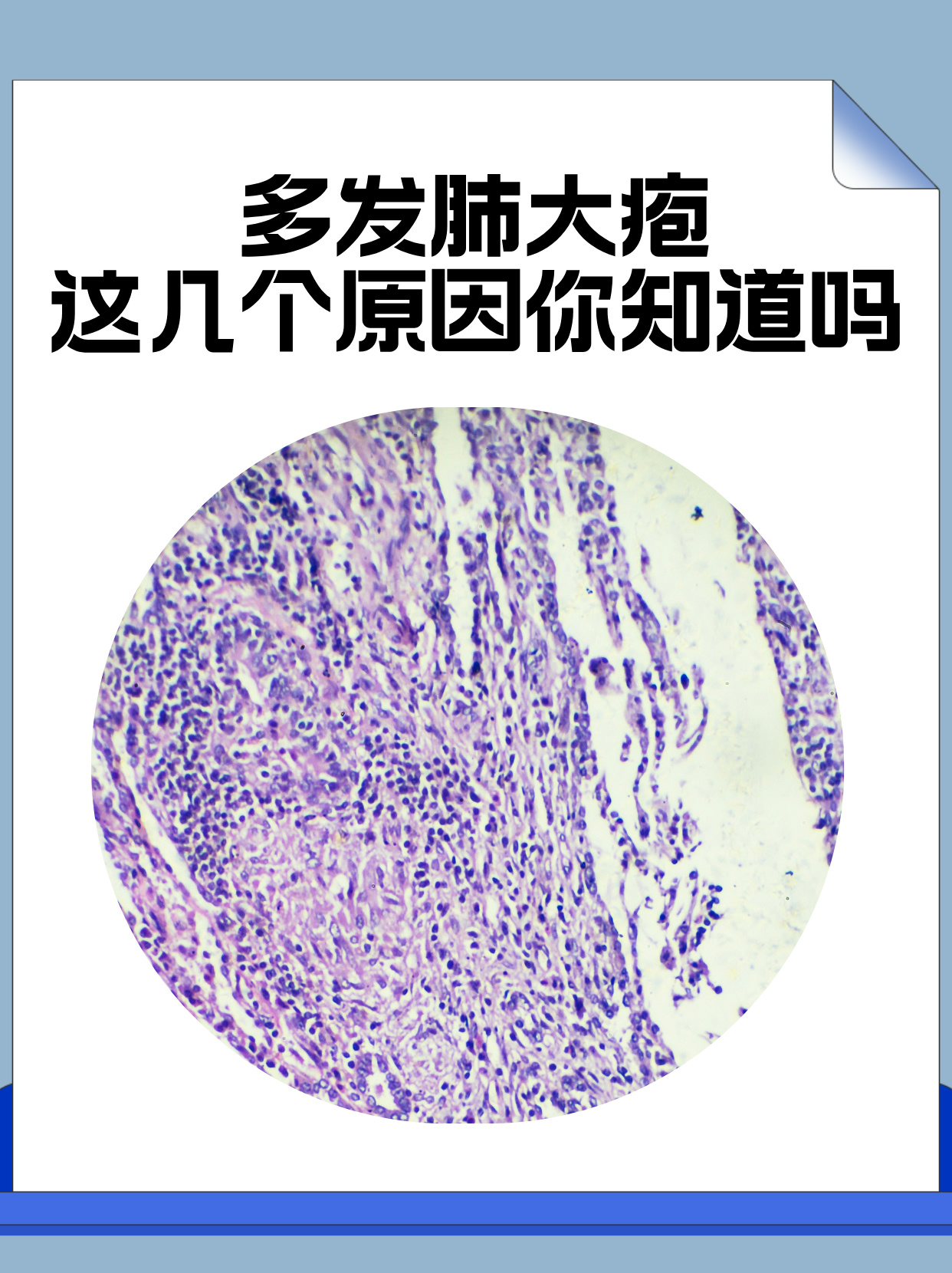 肺囊虫肺炎图片