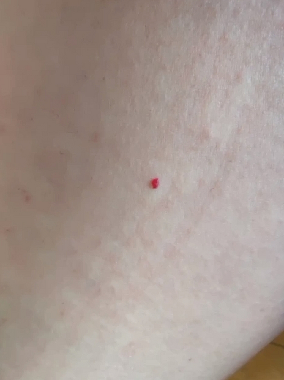 发现身体上长了不少红痣,听说长这样的红痣是身体变老的症状,看来岁月