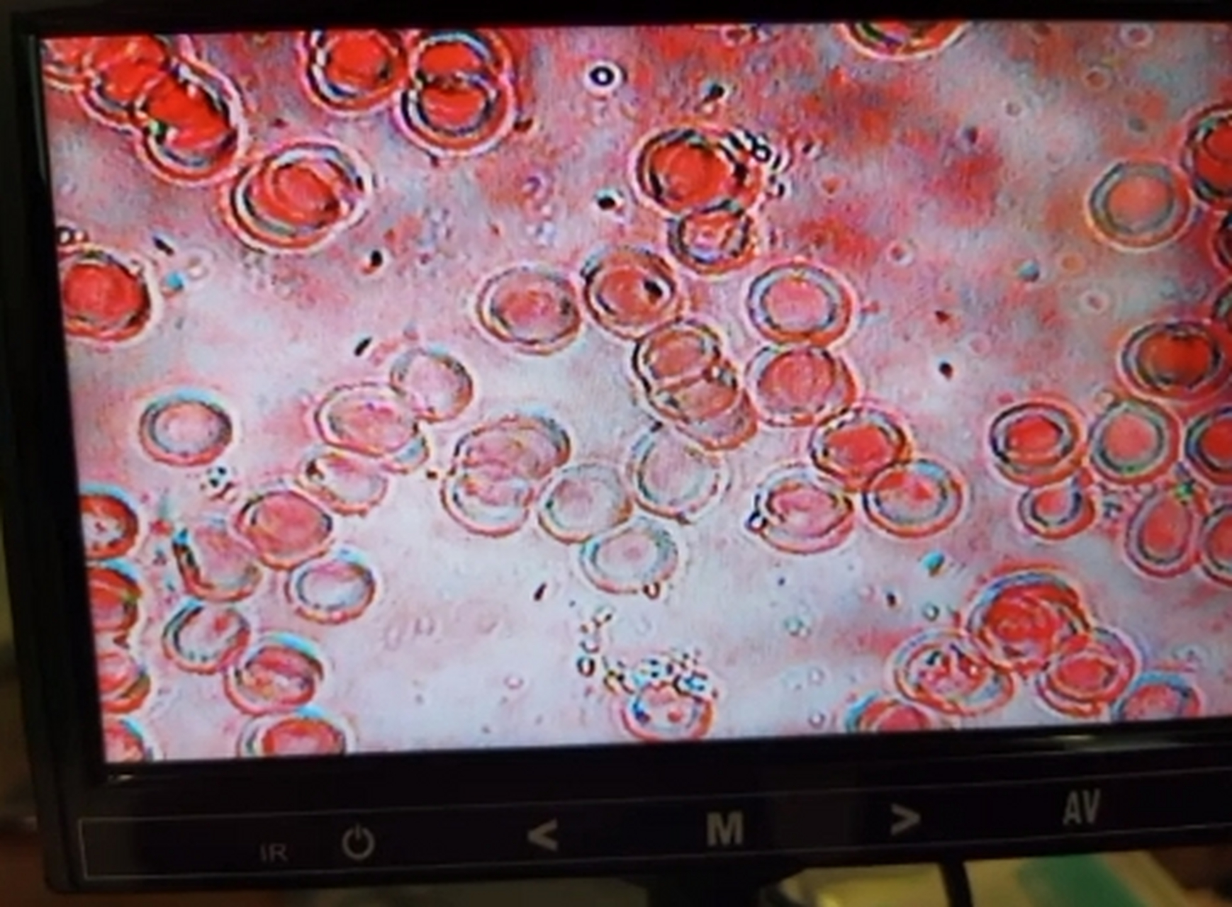 三个人的血在显微镜下的样子,哪个血最好?猜对有奖