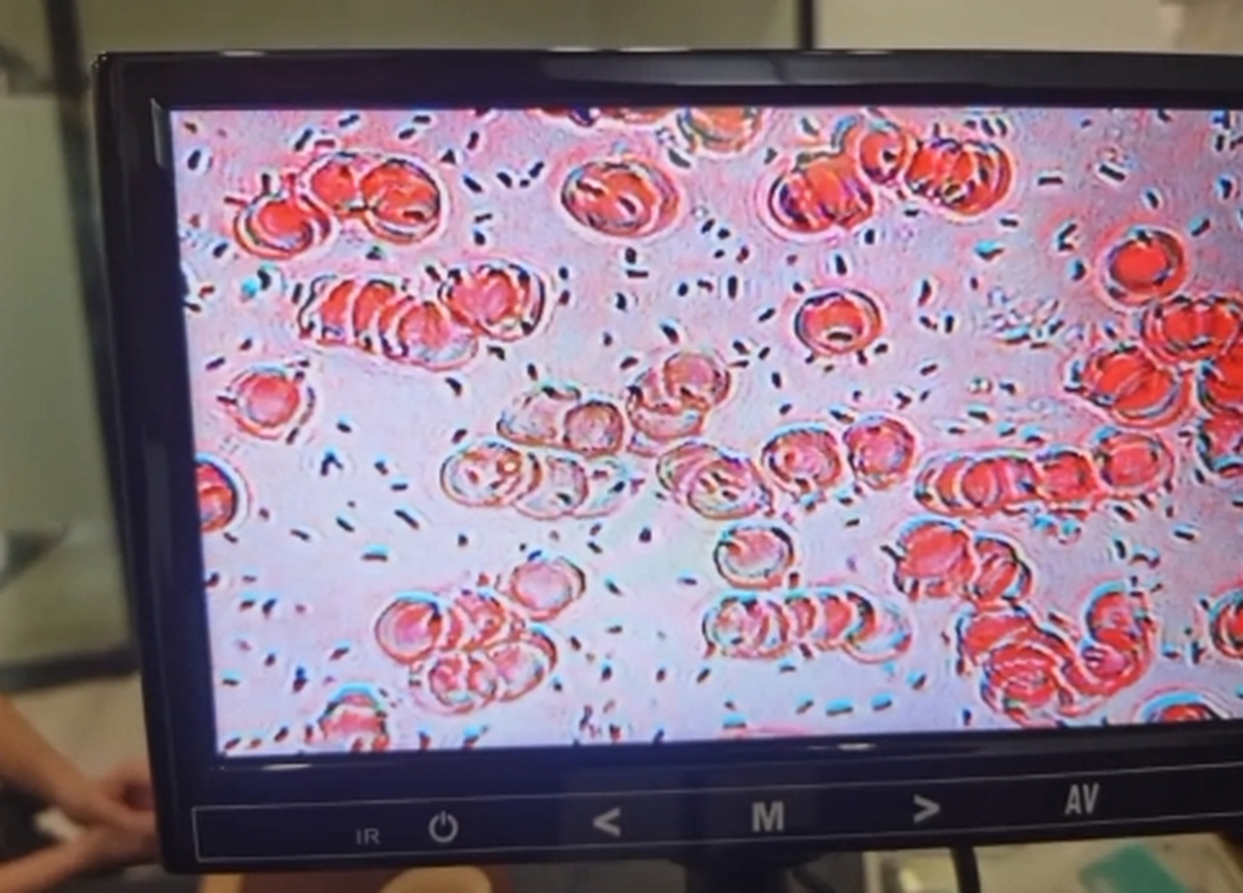 三个人的血在显微镜下的样子,哪个血最好?猜对有奖