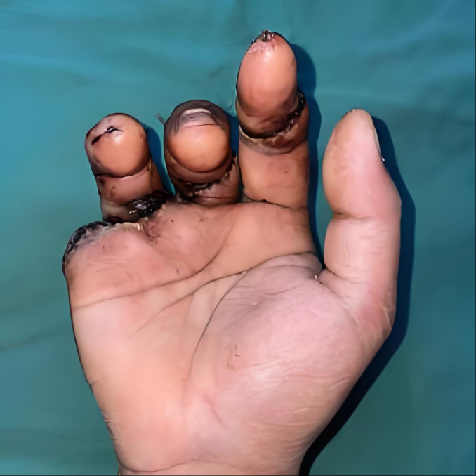 断指再植坏死是什么样 断指再植坏死会导致手指的部位出现发黑或者是