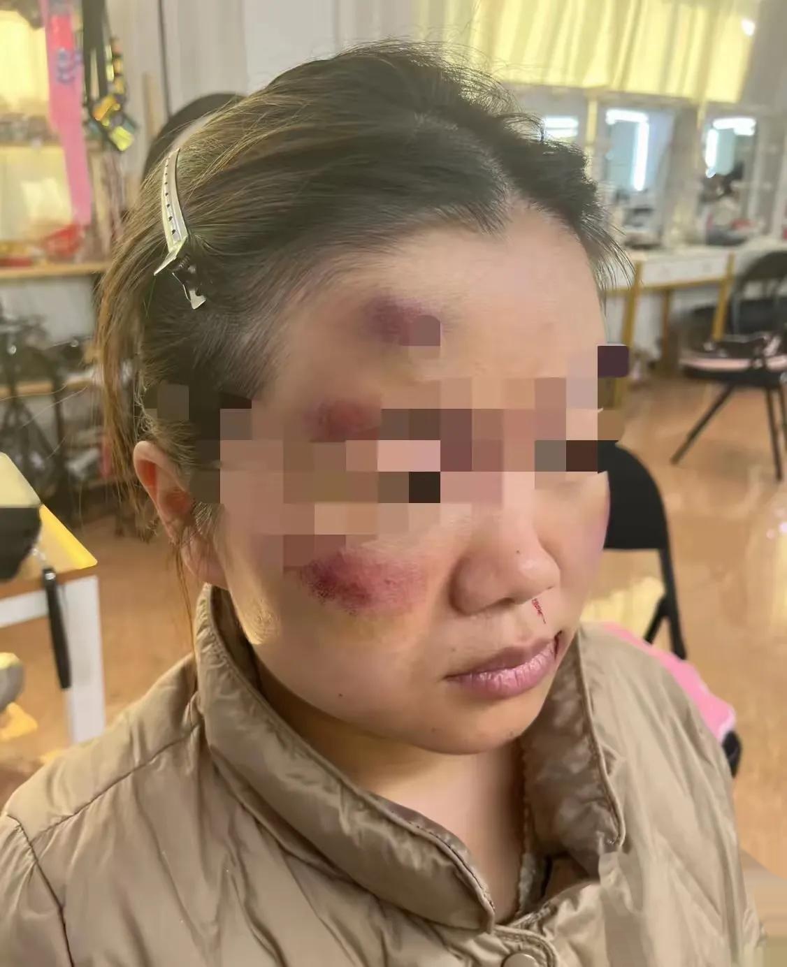 昨天我被家暴了,现在怀孕7个月就要生了,竟然被老公打了一顿,我没有哭