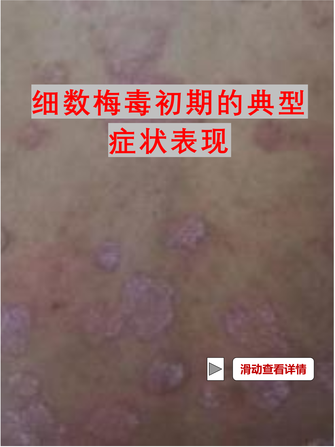 细数梅毒初期的典型症状表现