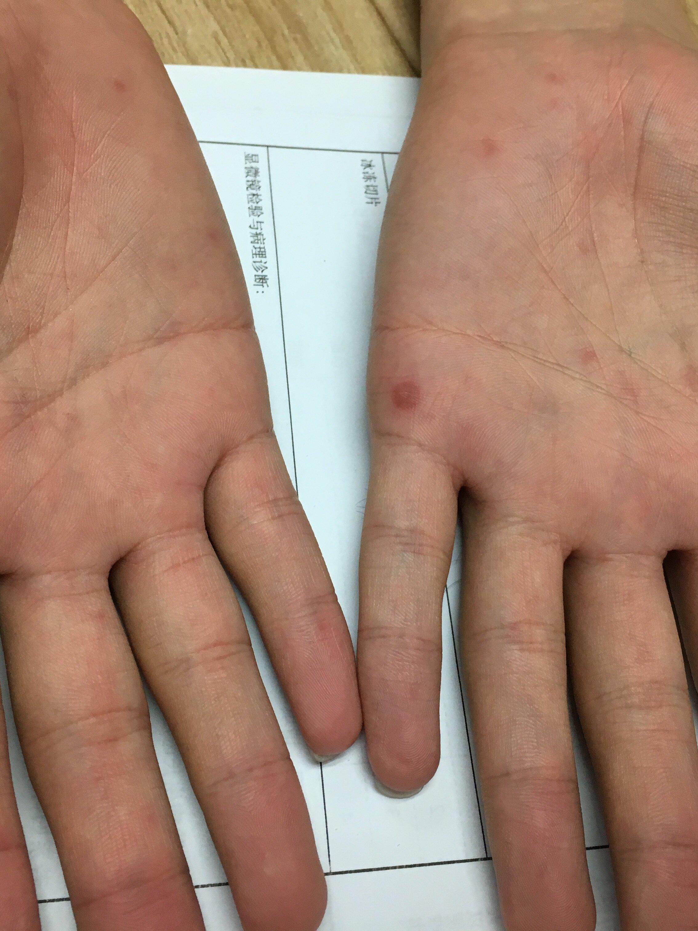 梅毒患者的皮肤护理需要格外谨慎,许多常见做法可能加重症状或导致