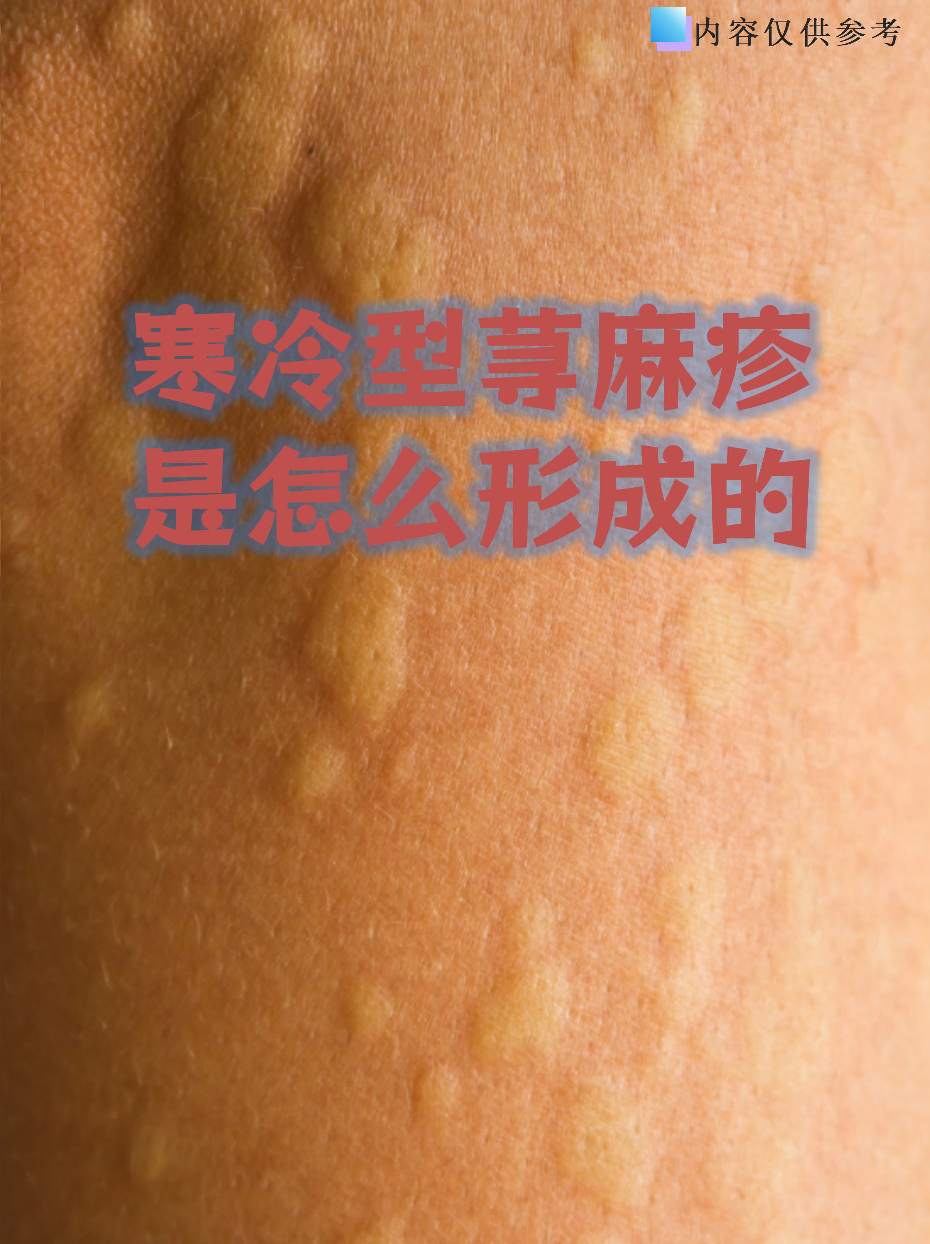 荨麻疹为什么冷水一冲就好了