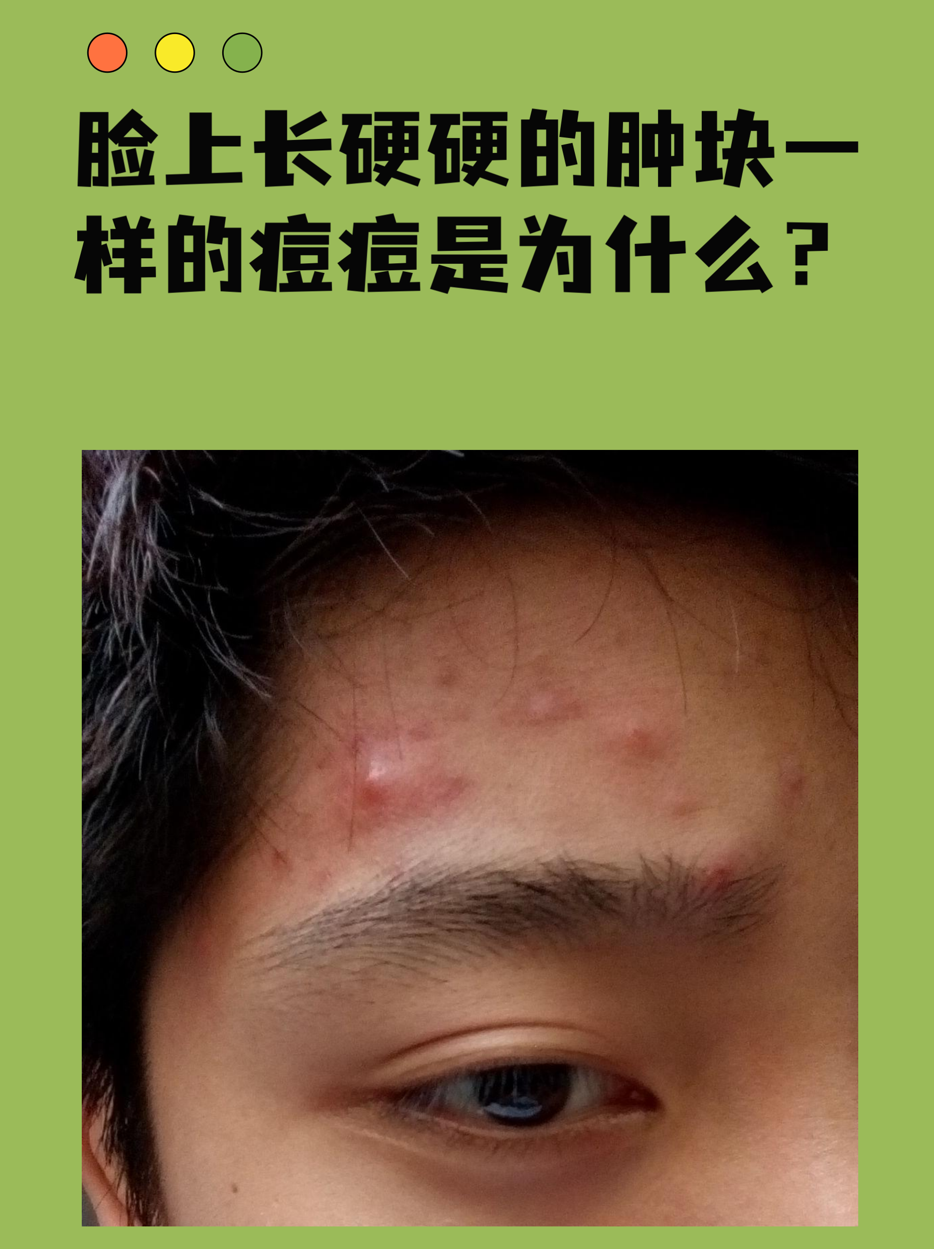 脸上长硬硬的肿块一样的痘痘是为什么?