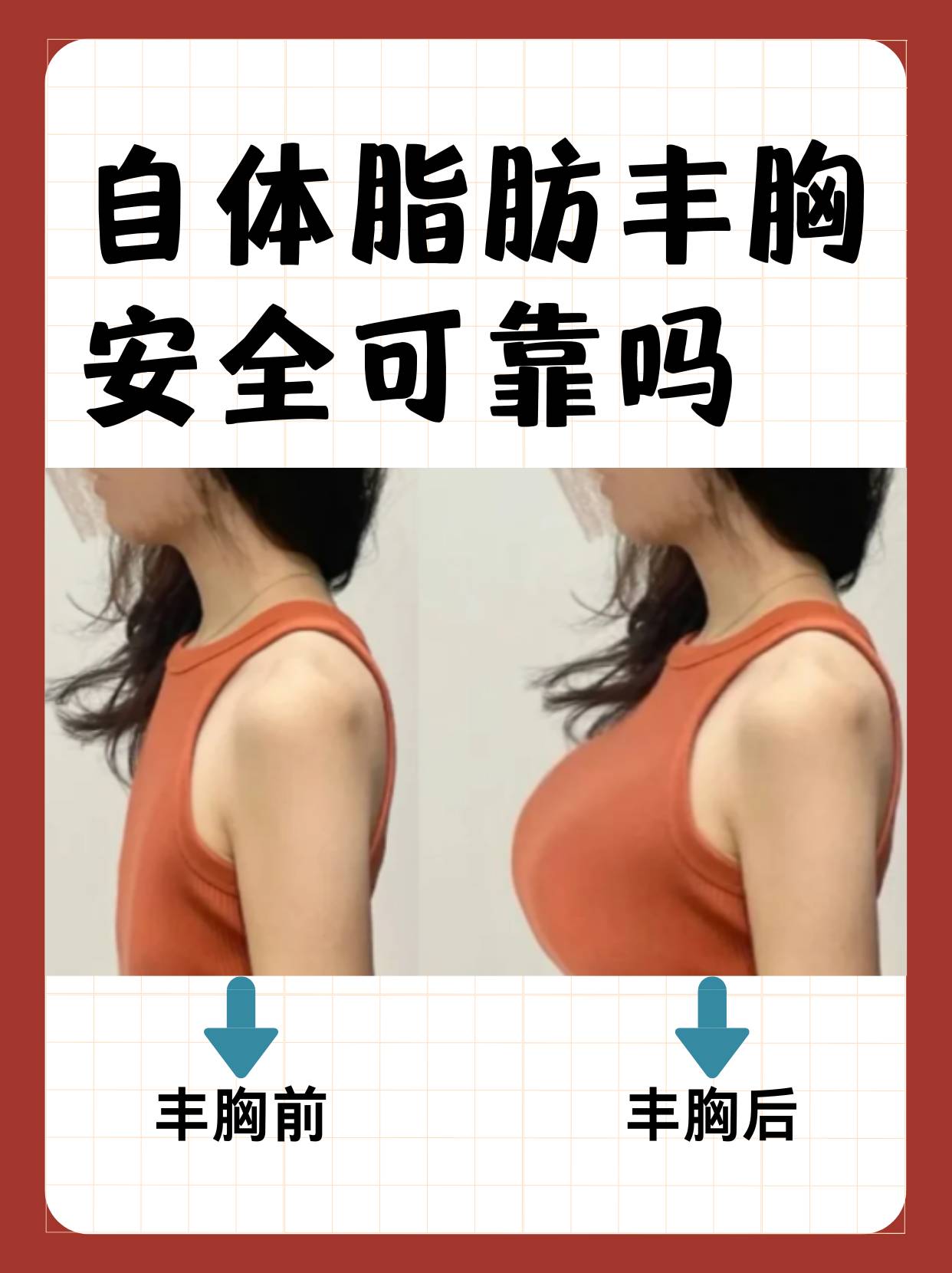 自体脂肪丰胸安全可靠吗  在追求美的道路上,许多女性都希望拥有更加