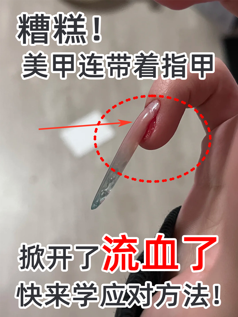 美甲连带着指甲掀开了流血了,快来学应对方法!