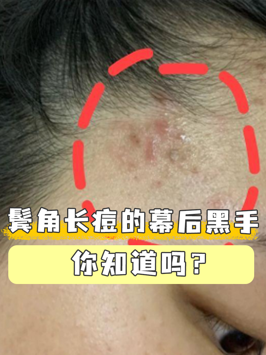 鬓角长痘的根源在于皮肤油脂分泌过多,毛囊堵塞以及细菌感染等多种