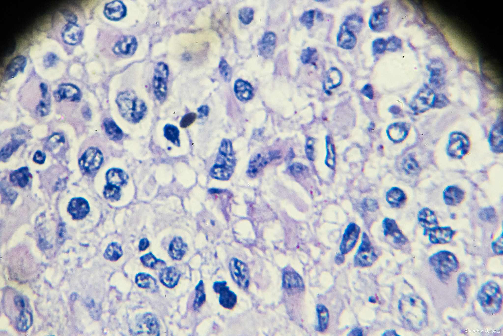 脊髓弥漫性星形细胞瘤,无法手术,可以做射波刀吗?