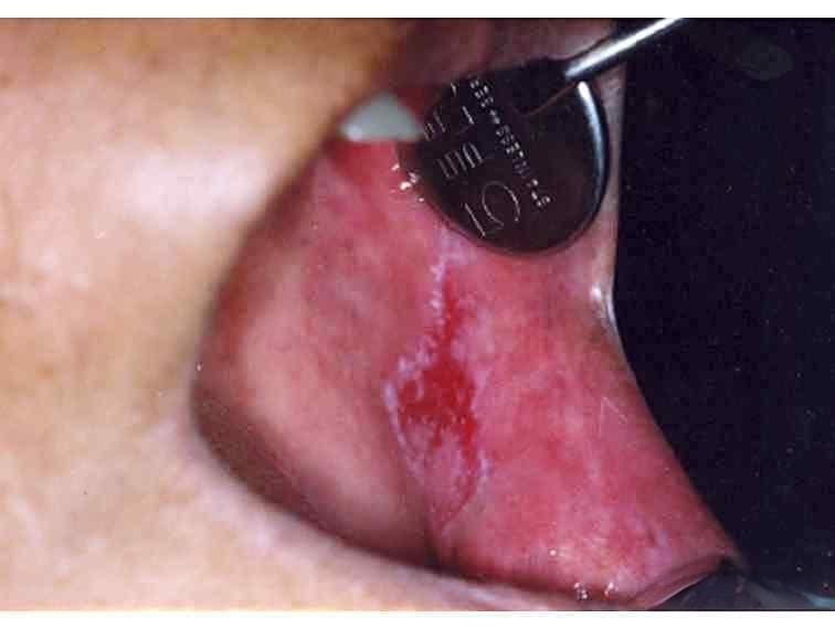 口腔溃疡为什么是白色的 口腔溃疡为什么是白色的