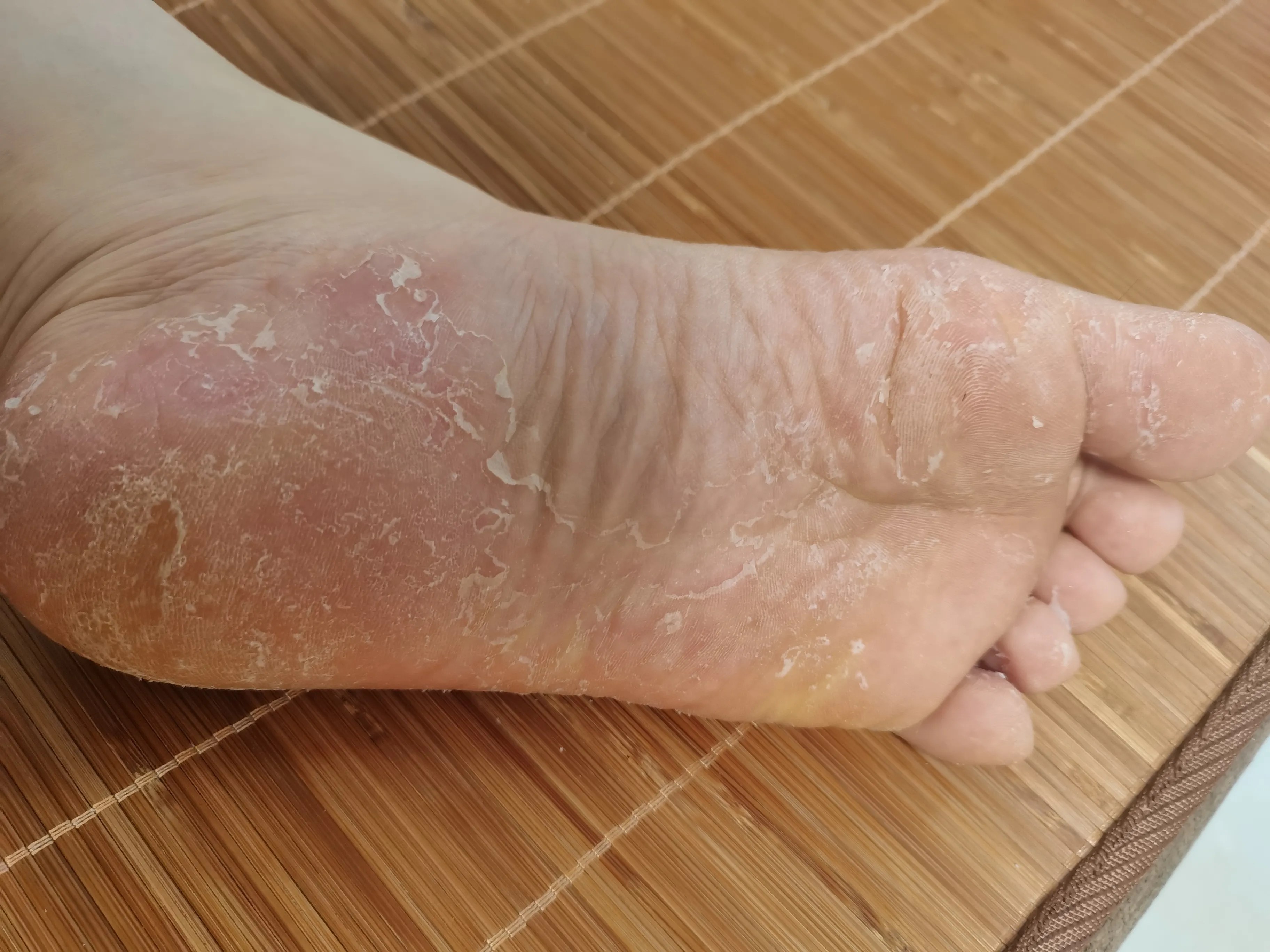 一患者被脚气缠了几十年咋治都不好