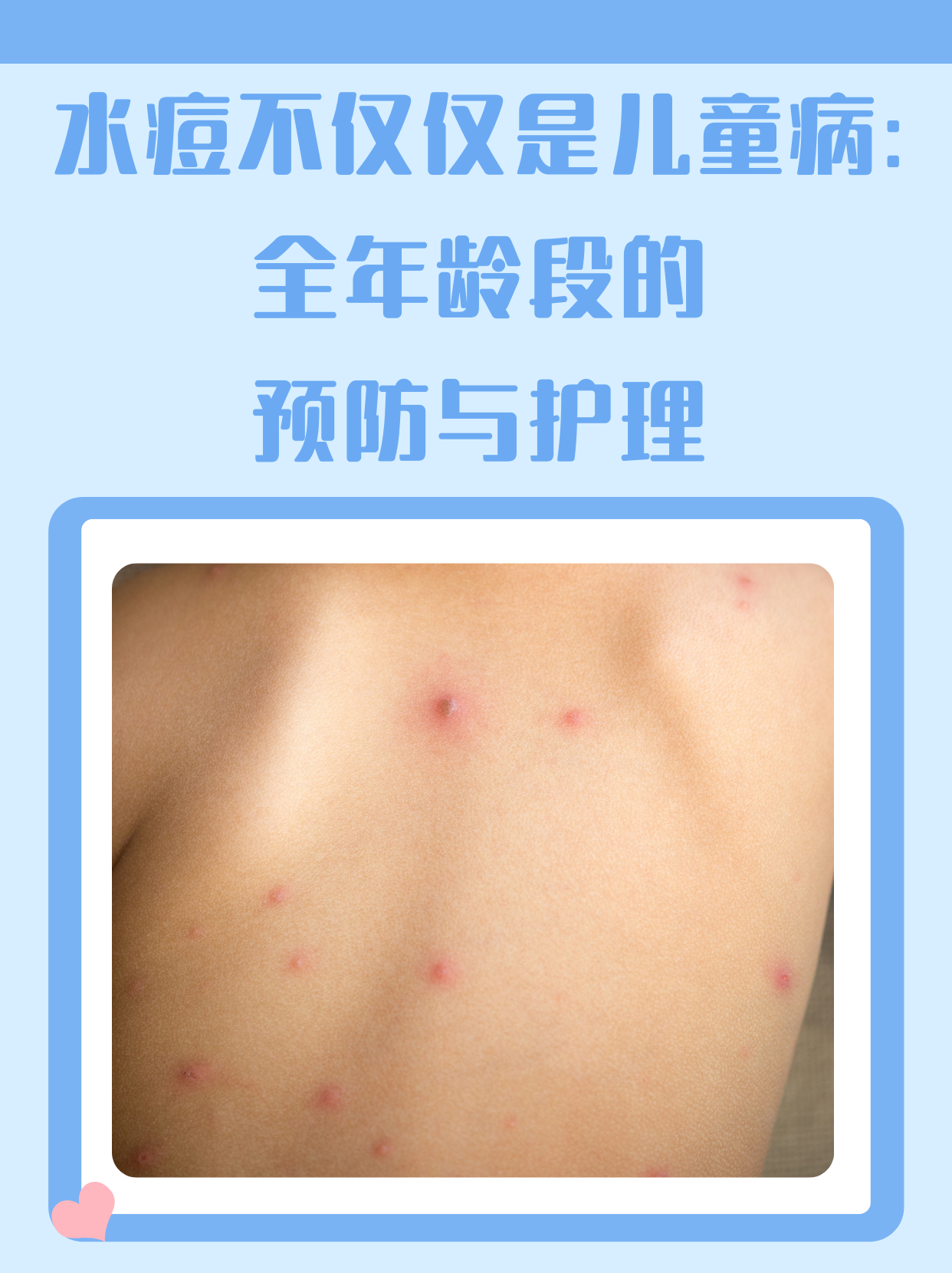 水痘不仅仅是儿童病:全年龄段的预防与护理
