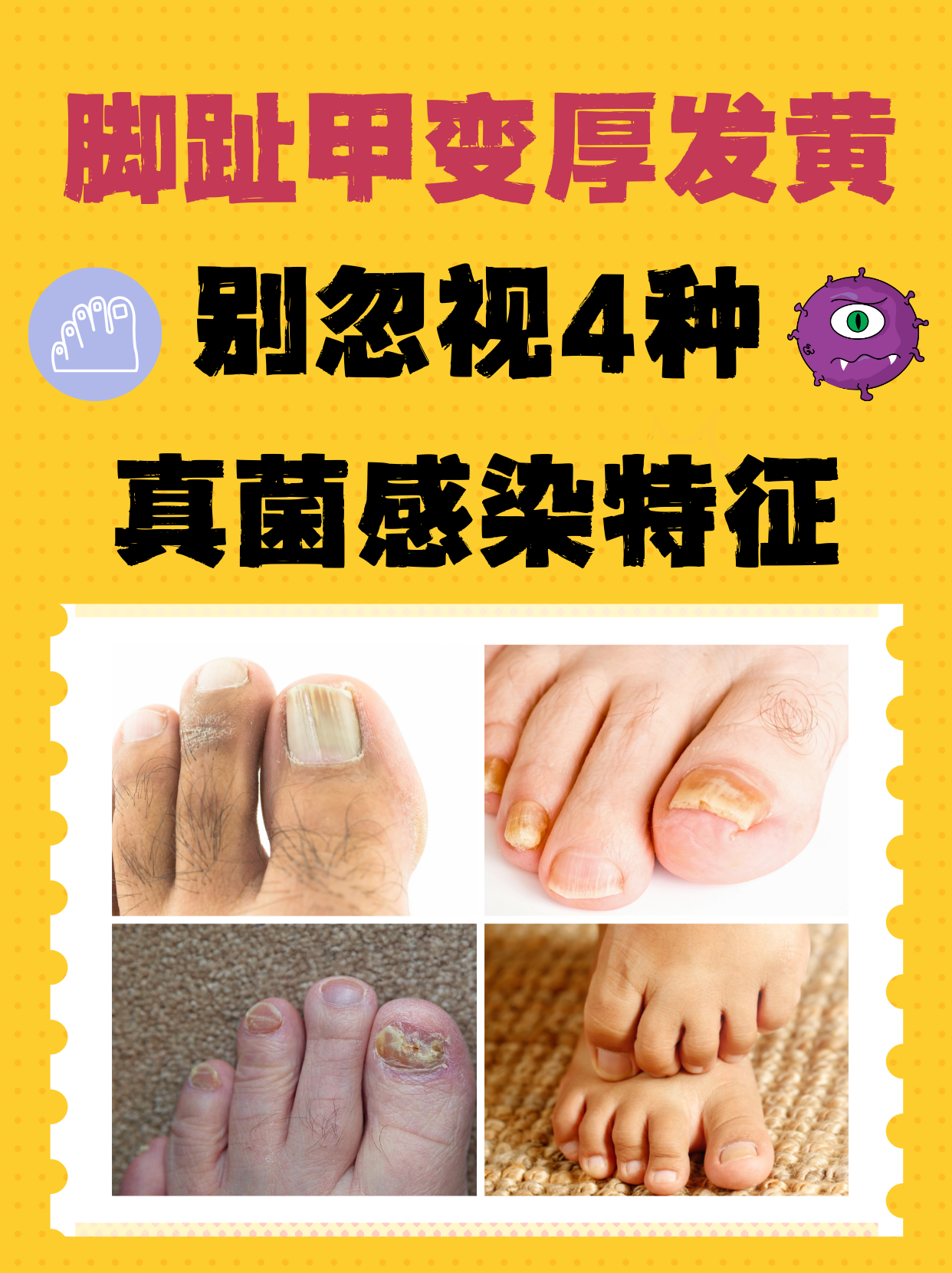 脚趾甲变厚发黄,别忽视4种真菌感染特征