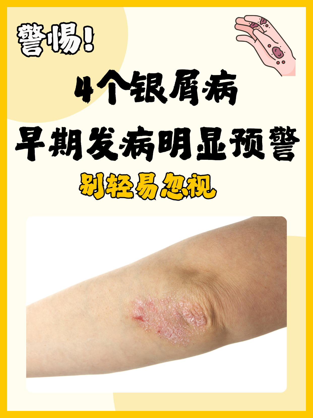 常伴有瘙痒,这些症状虽看似普通,却可能是银屑病悄然来袭的信号