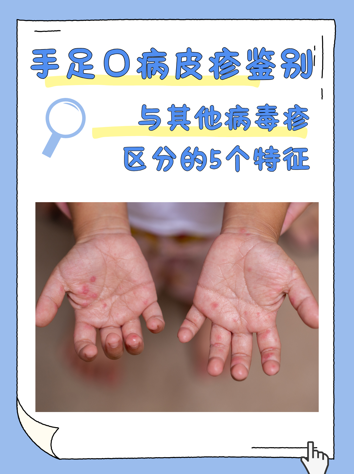 手足口病皮疹有特点,学会这5个区分特征,能避免误判～