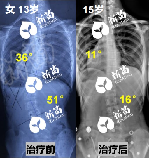 脊柱侧弯手术风险图片