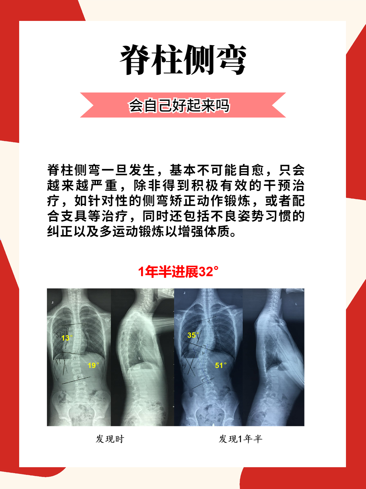 3.脊柱侧弯能通过运动训练来矫正吗? 4
