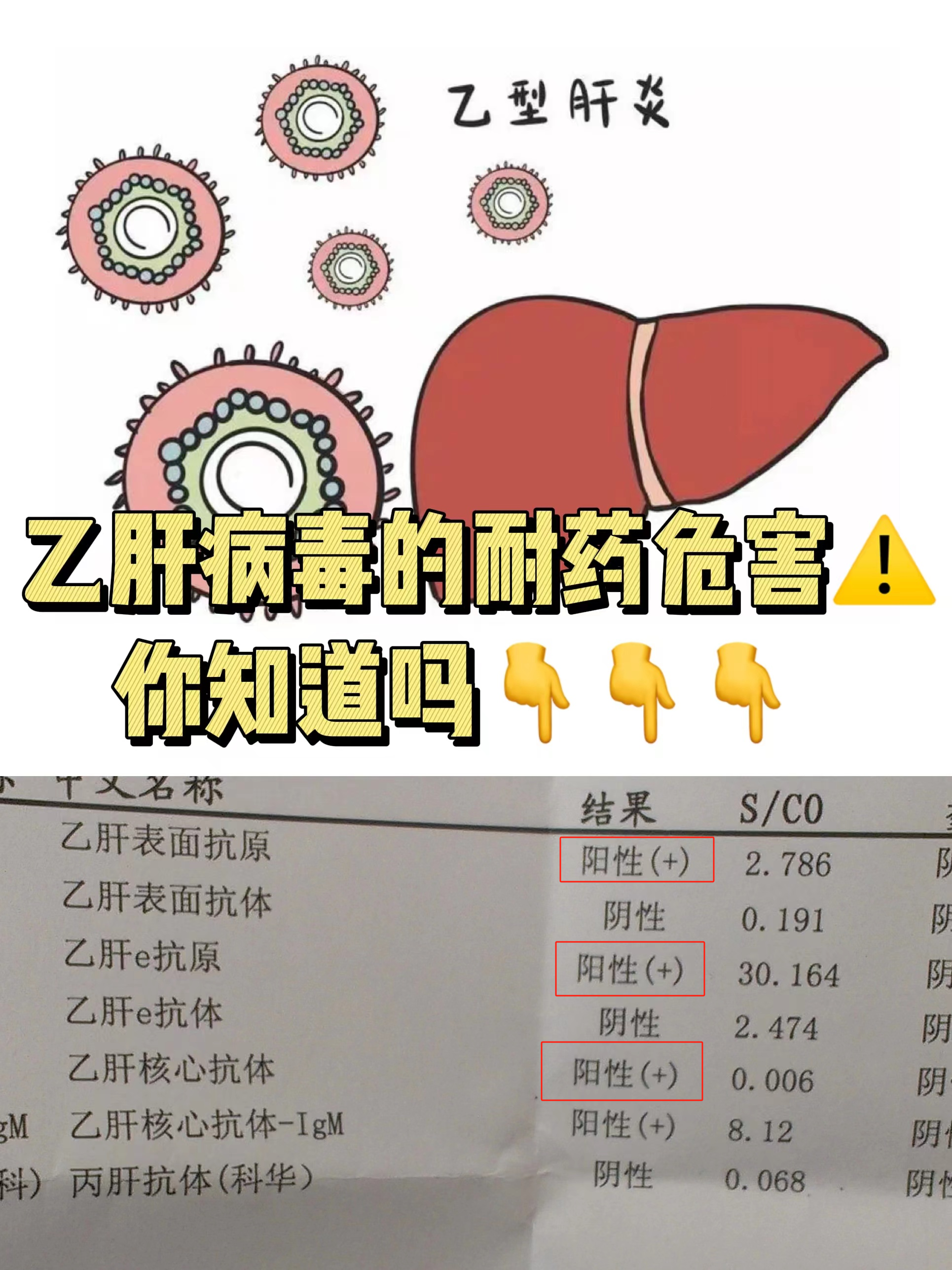 1,增加肝硬化,肝癌的几率,乙肝病毒耐药会导致无法抑制病毒复制,即篌