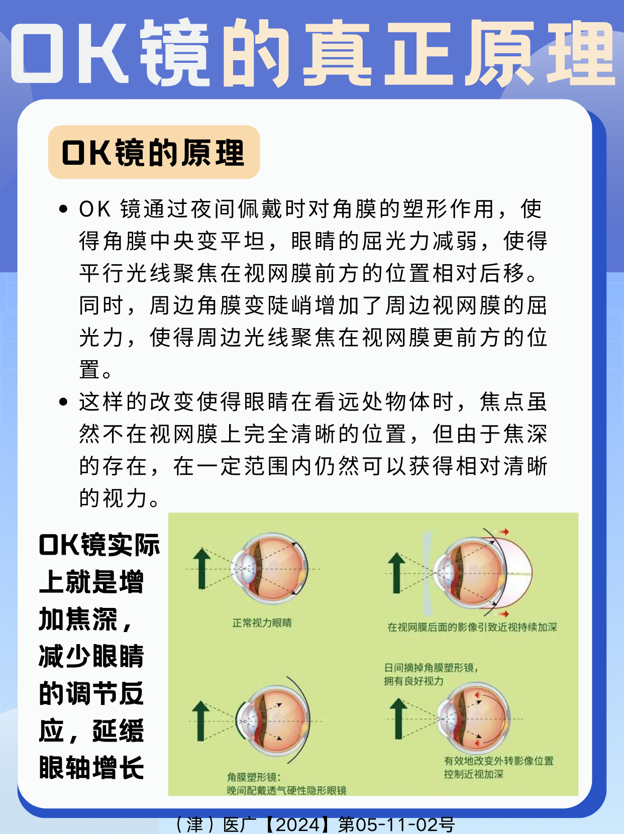 大家都知道角膜塑形镜