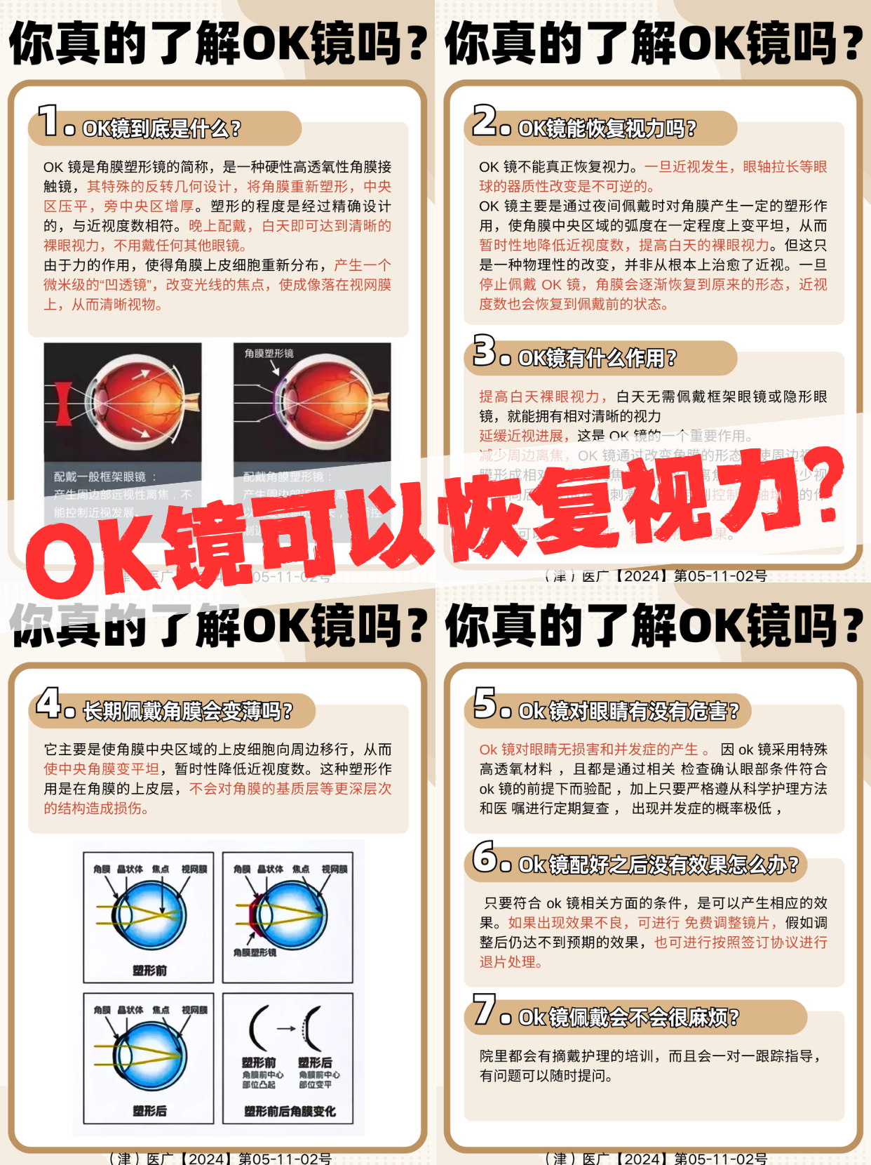 ok镜可以治疗近视眼吗图片