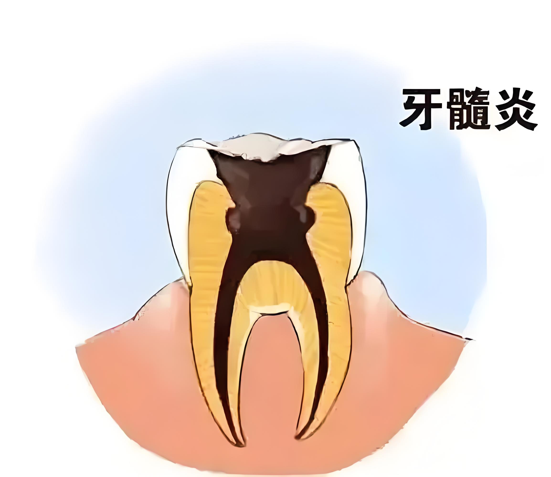 急性牙髓炎:探究其背后的元凶 急性牙髓炎,这一口腔急症,其病因多样且