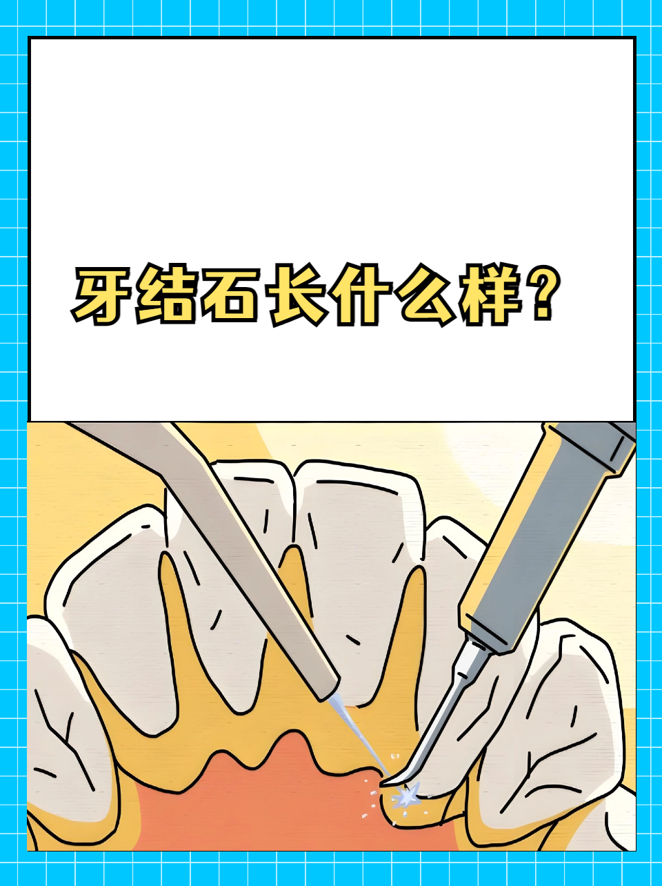 牙结石是附着在牙齿表面和牙缝中的黄褐色或黑色的钙化物质