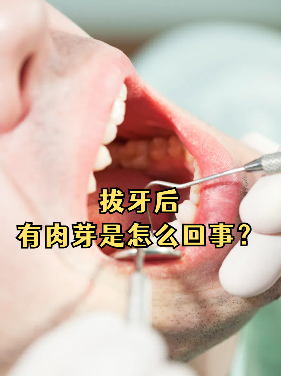 拔牙后长出肉芽,其实大多数情况下是正常现象