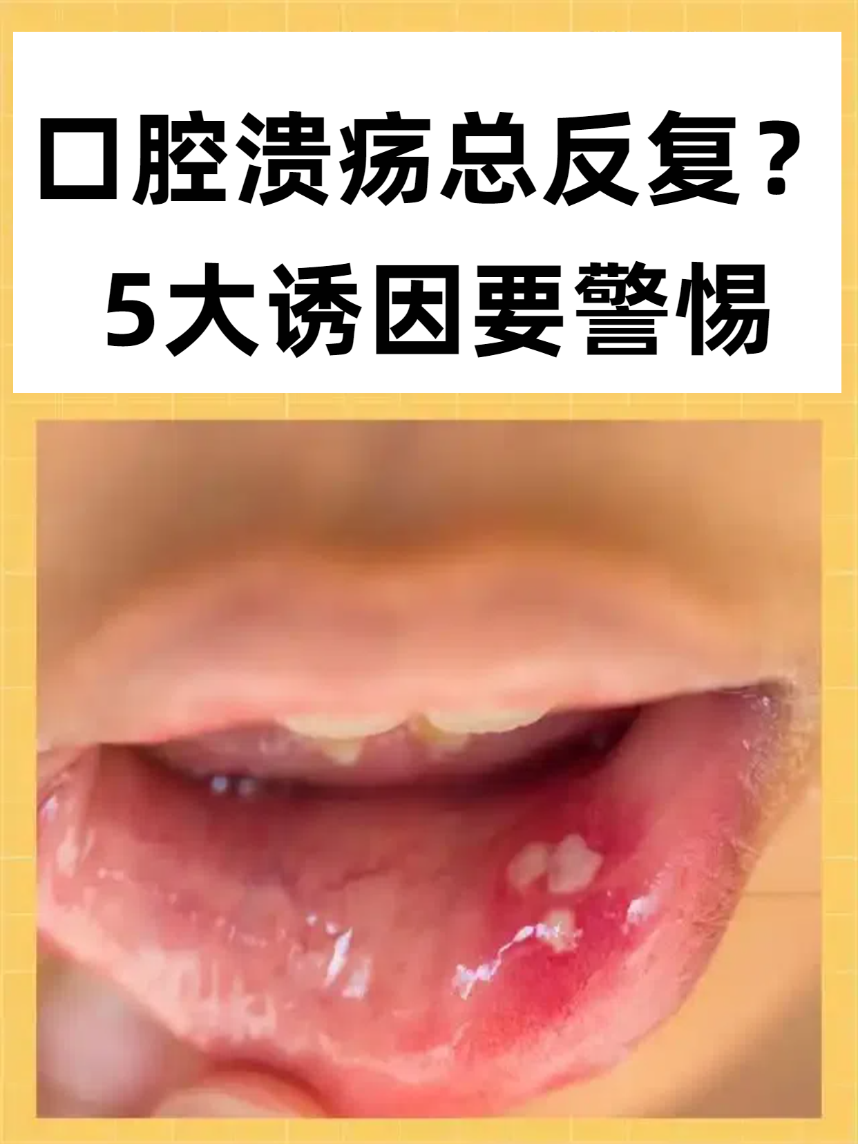 为什么老是得口腔溃疡