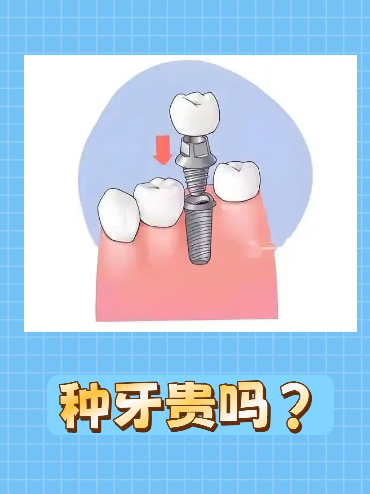 种植牙为什么那么贵