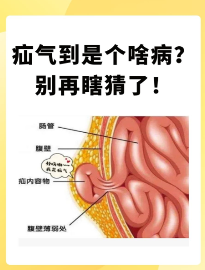 男性疝气是体内组织通过薄弱点突出的病