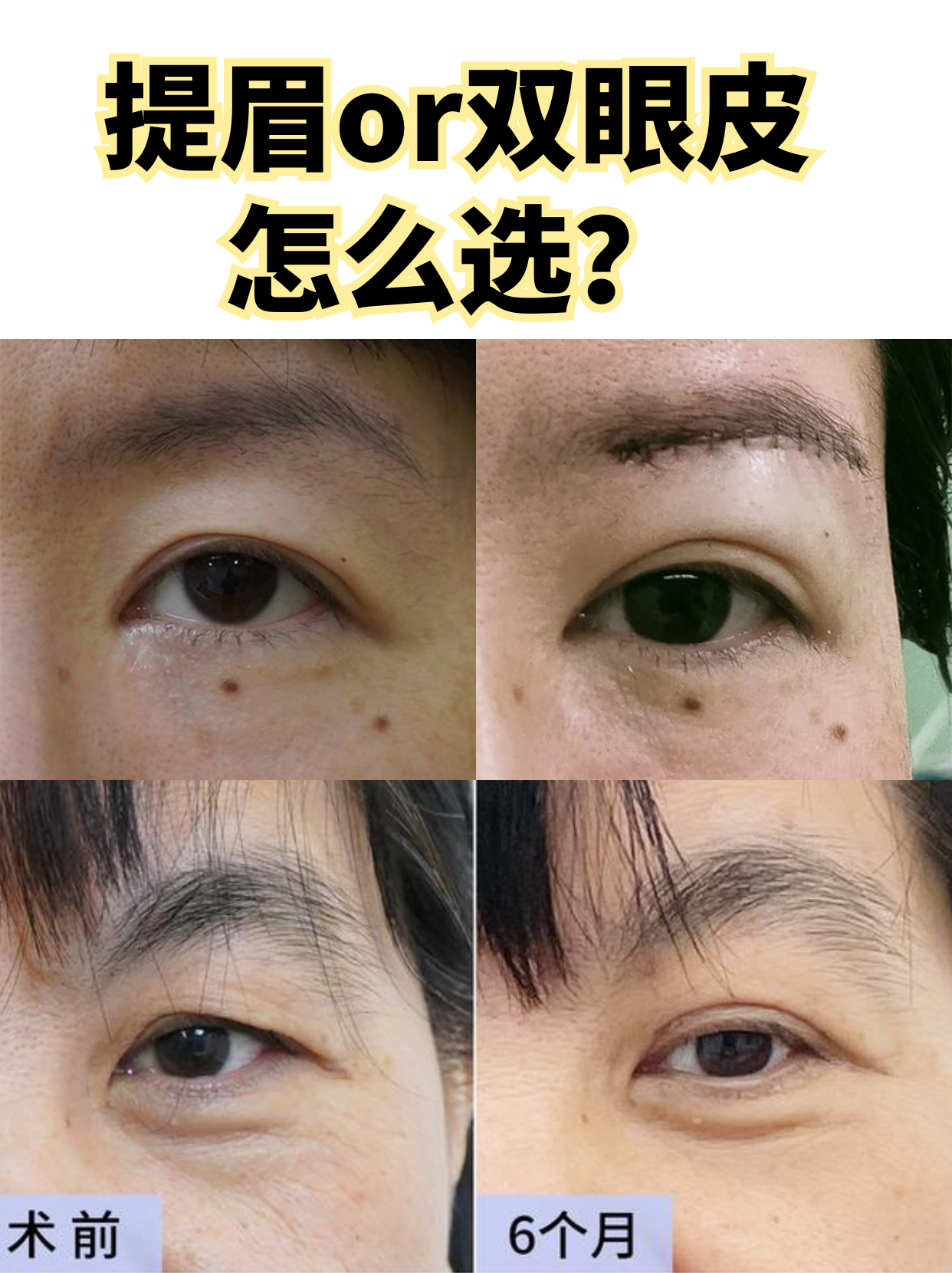 为什么眼皮松弛