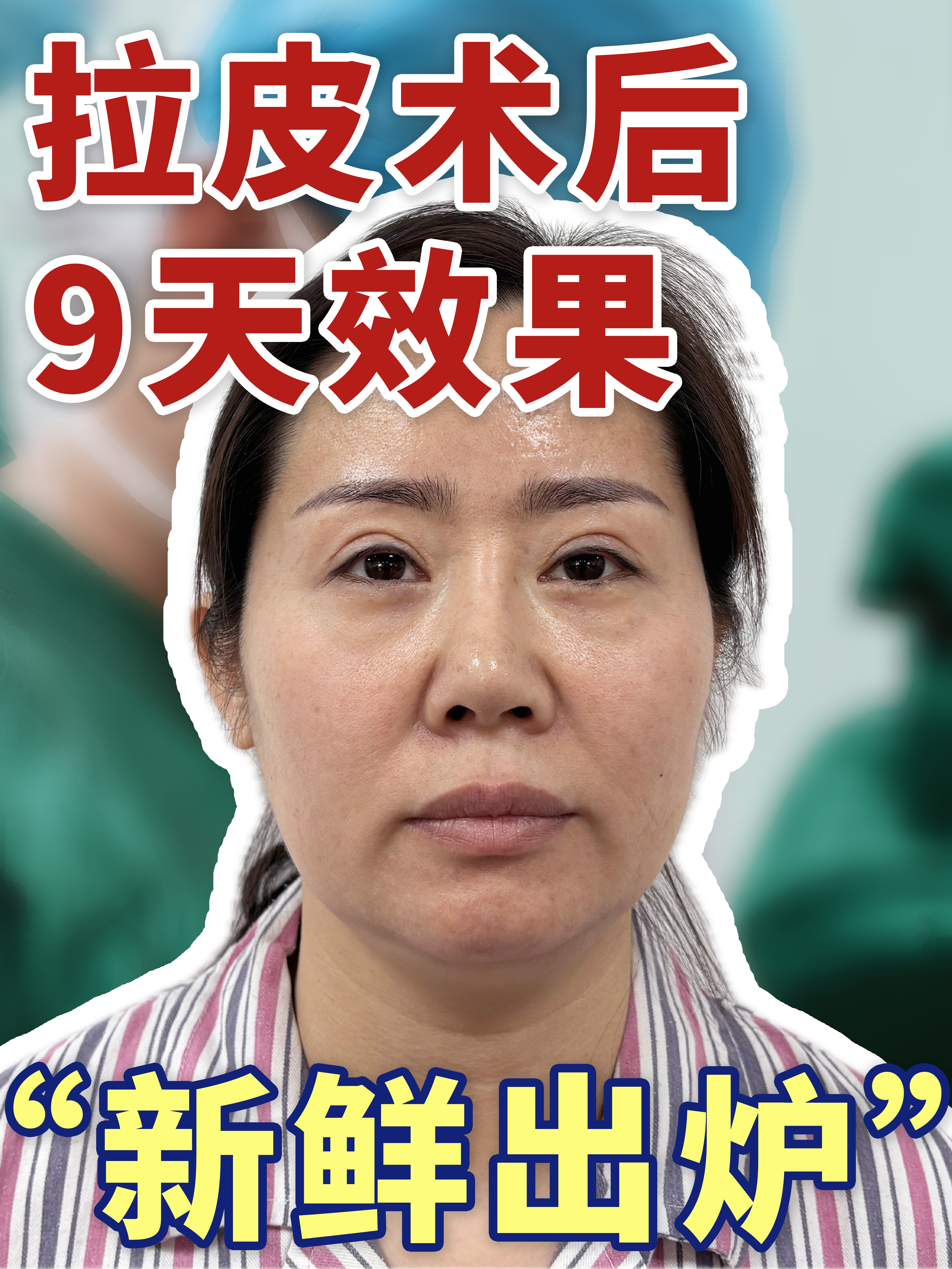 手术方案:中下面部颈部大拉皮 自体筋膜鼻基底填