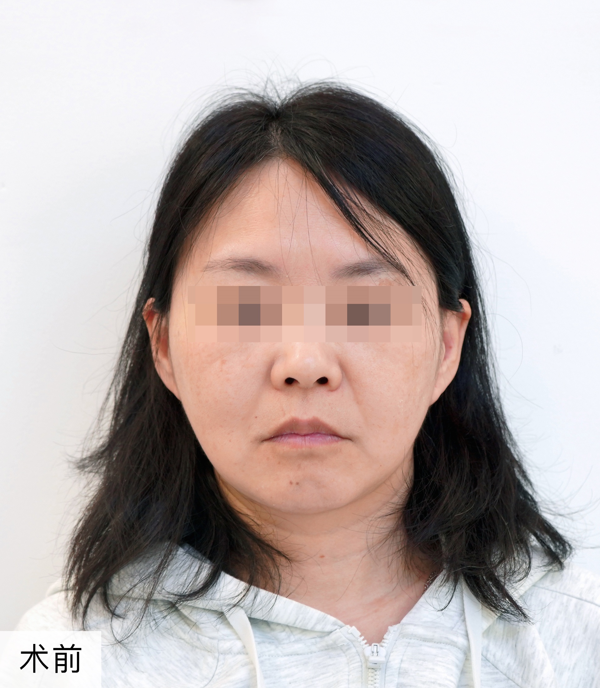 最想改善的问题下垂的苹果肌和鼻翼两侧法令纹